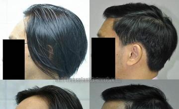 Before and after surgical hair restoration images