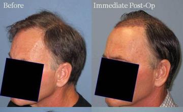 Hair restoration procedure before and after pictures