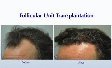 Hair transplantation surgery before and after photos