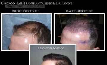 Hair transplantation surgery before and after pictures