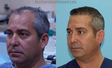 Hair restoration procedure before and after pictures