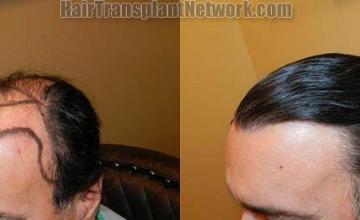 Hair transplantation surgery before and after photos