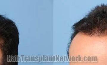 Hair transplantation surgery before and after photos