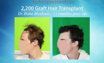 Hair restoration surgery before and after images