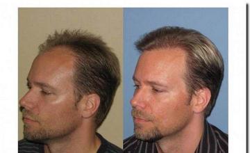 Hair restoration procedure results