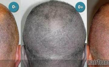  before and after images