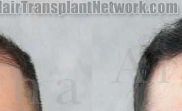 Before and after hair transplantation photographs