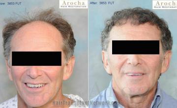 Hair transplantation surgery before and after photos