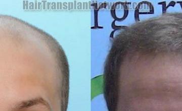 Hair restoration procedure before and after pictures