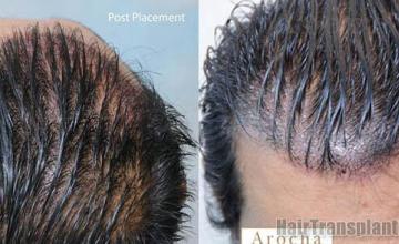 Hair transplantation surgery before and after images