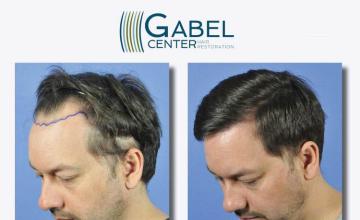 Hair transplantation surgery before and after pictures