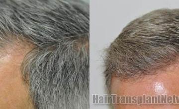 Left view before and after hair transplantation images