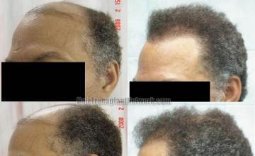 Hair transplantation surgery before and after pictures