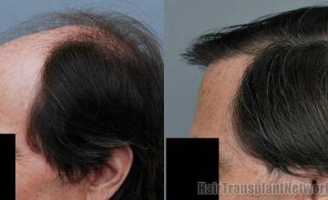 Hair transplantation surgery before and after images