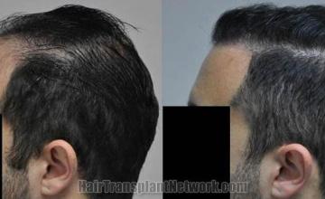 Hair transplantation surgery before and after images