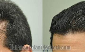 Hair transplantation surgery before and after pictures