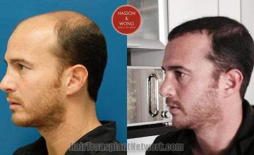 Hair transplantation surgery before and after pictures