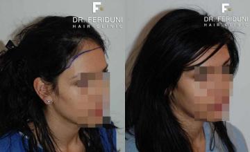 Hair restoration procedure before and after results