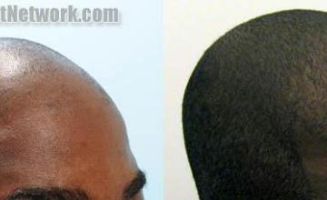 Hair transplantation surgery before and after images