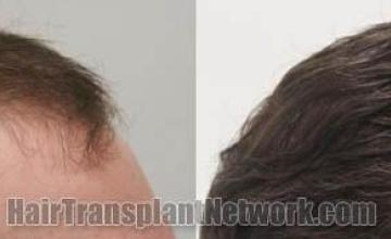 Hair transplantation surgery before and after images