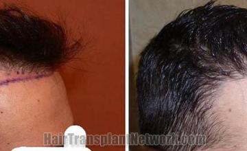 Hair transplantation surgery before and after photos