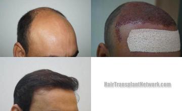 Hair transplantation surgery before and after photos
