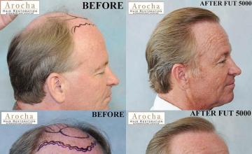 Hair transplantation surgery before and after photos