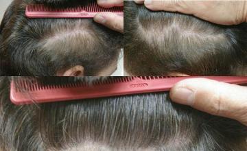 Residual donor area scar from hair transplantation