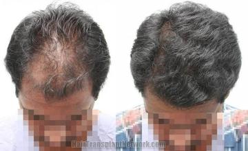 Top view - Before and after surgical hair replacement