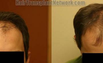 Hair restoration procedure before and after results