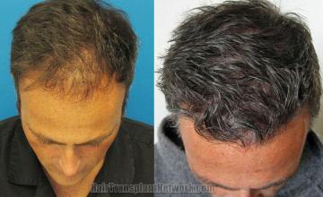 Hair transplantation surgery before and after images