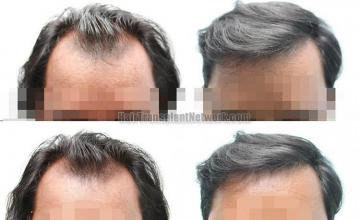 Before and after hair transplantation result photographs