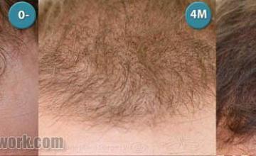 Hair transplantation surgery before and after pictures