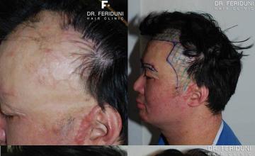 Left profile view before and after hair restoration on burn victim