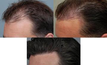 Hair restoration procedure before and after pictures