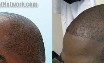 Hair transplantation surgery before and after pictures