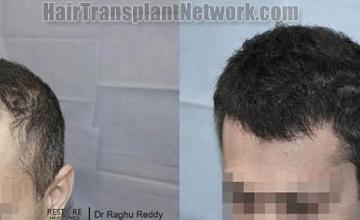 Hair transplantation surgery before and after images