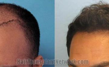 Hair transplantation surgery before and after images