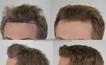 Hair transplantation surgery before and after pictures