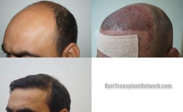 Hair restoration procedure before and after pictures