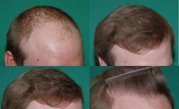 Hair restoration procedure before and after results