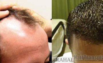 Hair transplantation surgery before and after photos