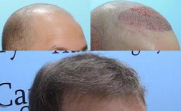 before and after images