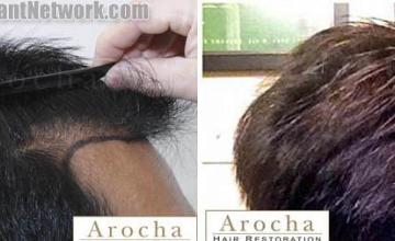 Hair restoration procedure before and after results