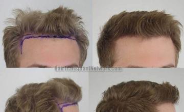 Hair transplantation surgery before and after images