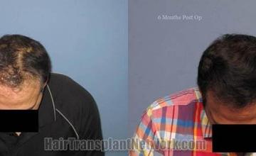 Hair transplant surgery before and after image