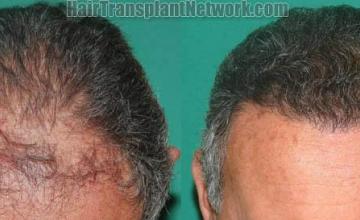 Hair transplantation surgery before and after photos