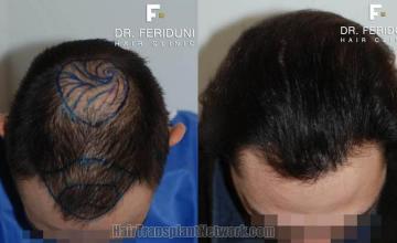 Hair transplantation surgery before and after photos