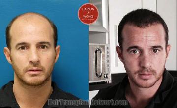 Hair transplantation surgery before and after photos