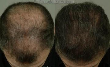 Top view - Before and after surgical hair replacement